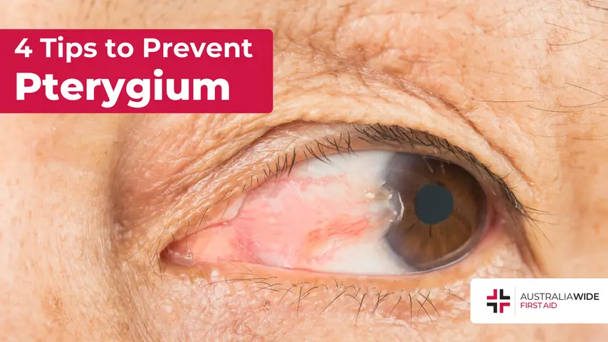 Prevent pterygium article header